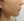 เลเซอร์ Fraxel (Fractional Laser) — หลังทำ (7วัน) · คลินิก Le Shine