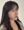 顴骨肉毒桿菌注射 — 術後 (7天) · U-Line醫美診所