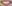 歯肉整形（ガミースマイル治療） — D-day歯科クリニック