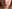 Double chin liposuction (submental liposuction) — Seoul During Clinic