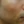 Surfect Lifting (4MHz monopolar RF lifting) — after (60days) · Only Lift Clinic