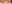 裏ハムラ法（経結膜的眼窩脂肪移動術） — ハッシュ美容外科クリニック
