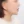 下巴異物取出（下巴假體移除） — 術後 (60天) · Returning醫美診所