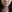 Thread lift — Wivers Plastic Surgery Clinic