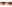 涙袋形成（脂肪注入） — ファクト美容外科クリニック