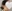 口角ボトックス（口角挙上ボトックス） — ロリポップ美容外科クリニック