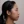 Thread embedding acupuncture lift (Korean-medicine 'maeseon' acupoint thread lift) — before · Garoseo Oriental Clinic - Gangnam Branch