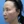 Ultherapy (Ulthera) micro-focused ultrasound lift — after · K-Tox Clinic - Incheon Guwol Branch