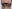 Double chin liposuction (submental liposuction) — Seoul During Clinic
