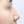 Nasal osteotomy (nasal bone narrowing) — before (7days) · Pop Plastic Surgery Clinic