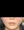 Thread embedding acupuncture lift (Korean-medicine 'maeseon' acupoint thread lift) — after · Pomedi Korean Medicine Clinic