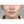 ผ่าตัดลดโหนกแก้มแบบเร็ว (ไม่ใส่ตัวยึด) — ก่อนทำ (90วัน) · ID Hospital - โรงพยาบาลหลัก