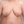 ผ่าตัดลดขนาดหน้าอก — ก่อนทำ (28วัน) · The Plastic Surgery Clinic
