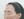 Forehead reduction (hairline lowering surgery) — before (8days) · Goyu Plastic Surgery Clinic