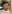 Bulbous nose correction (surgical nasal tip reduction) — Coco Line Clinic