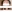 裏ハムラ法（経結膜的眼窩脂肪移動術） — ファクト美容外科クリニック