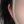 耳垂整形（丰耳垂/耳垂修复） — 术后 (30天) · 麒麟医美诊所