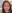 Nasal Tip Plasty with Autologous Cartilage — Sharp Plastic Surgery