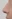 Nasal Tip Plasty with Autologous Cartilage — Litmus Plastic Surgery