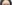 額（おでこ）のヒアルロン酸注入 — フルルン美容外科クリニック