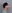 雙下巴抽脂 — Saekim 整形外科診所