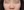 ตัดปีกจมูก (Alarplasty) — ก่อนทำ · คลินิกศัลยกรรม TJ (TJ Plastic Surgery)