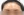 Forehead reduction (hairline lowering surgery) — before (14days) · iLumi Plastic Surgery Clinic