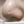 acne scar subcision / regenerative needling — before (120days) · Rodam Korean Medicine Clinic - Jamsil Branch