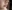 Lip filler (lip augmentation with HA) — Dress Plastic Surgery Clinic