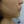 Surfect Lifting (4MHz monopolar RF lifting) — before (90days) · Only Lift Clinic