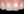 Composite resin filling — after · Yonsei Good Day Dental Clinic - Yangjae Branch