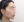 皮質骨切除術（下顎外板骨切り） — 術前 (60日) · アイルミ美容外科クリニック