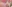 裏ハムラ法（経結膜的眼窩脂肪移動術） — プレジャー美容外科クリニック