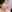 鼻尖形成術（自家軟骨移植） — マスト美容外科クリニック