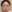 裏ハムラ法（経結膜的眼窩脂肪移動術） — プレジャー美容外科クリニック