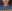 Double chin liposuction (submental liposuction) — Seoul During Clinic