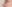 団子鼻修正（鼻尖縮小術） — タンキュー美容外科クリニック