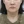 颈部提升术（颈纹拉皮） — 术前 (14天) · 丽莫医美诊所