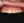 Composite resin filling — before (1days) · Yeonsedaegam Dental Clinic