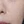 Clarity II (Lutronic dual-wavelength laser) — after (60days) · A-Top Plastic Surgery Clinic