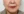 JUVGEN (autologous dermal regeneration / collagen-induction injection) — before (14days) · Saeroun Plastic Surgery