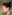 Platysma plication (corset platysmaplasty for double chin/jawline) — Shinsang Plastic Surgery Clinic