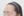 Forehead reduction (hairline lowering surgery) — before (8days) · Goyu Plastic Surgery Clinic