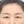 内視鏡下眉毛挙上術（内視鏡ブローリフト） — 術前 (14日) · エイビー美容外科クリニック