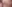 糸リフト（スレッドリフト） — ウア美容外科クリニック