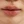 Chin botox (mentalis muscle botulinum toxin) — after · Dr. Sem Magic Beauty Clinic