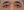 lower blepharoplasty (under-eye bag removal with fat repositioning) — after (7days) · Custom Plastic Surgery Clinic