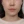 Ultraformer III (อัลตร้าฟอร์เมอร์) — ก่อนทำ · คลินิกรีไฟน์