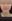 Chin reduction (chin bone shaving / narrowing genioplasty) — Uri Plastic Surgery Clinic