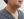 Neck wrinkle Botox (platysma band Botox / Nefertiti lift) — after (14days) · Yeonse Felice Women's Clinic